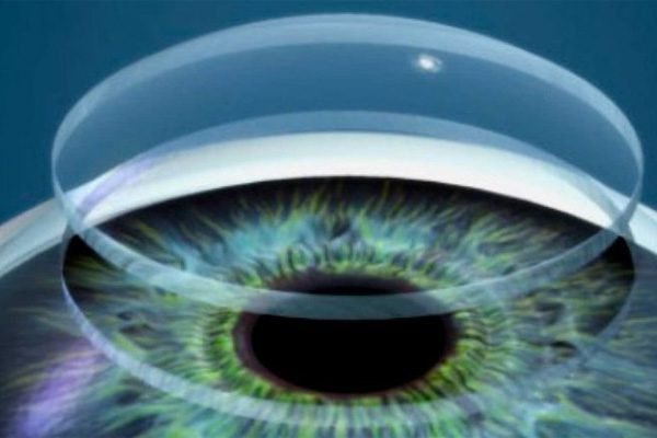 Transplante de Cornea sp