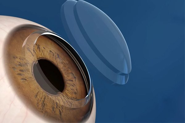Transplante de Córnea - clinica