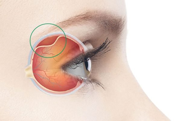 Cirurgias Vitreo-Retinianas - Clinica